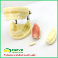 IMPLANT06(12617) Implant Practice Jaw Model with Lower Jaw for Flap and Drilling Practice